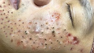 Loan Nguyen Acne Treatment #194