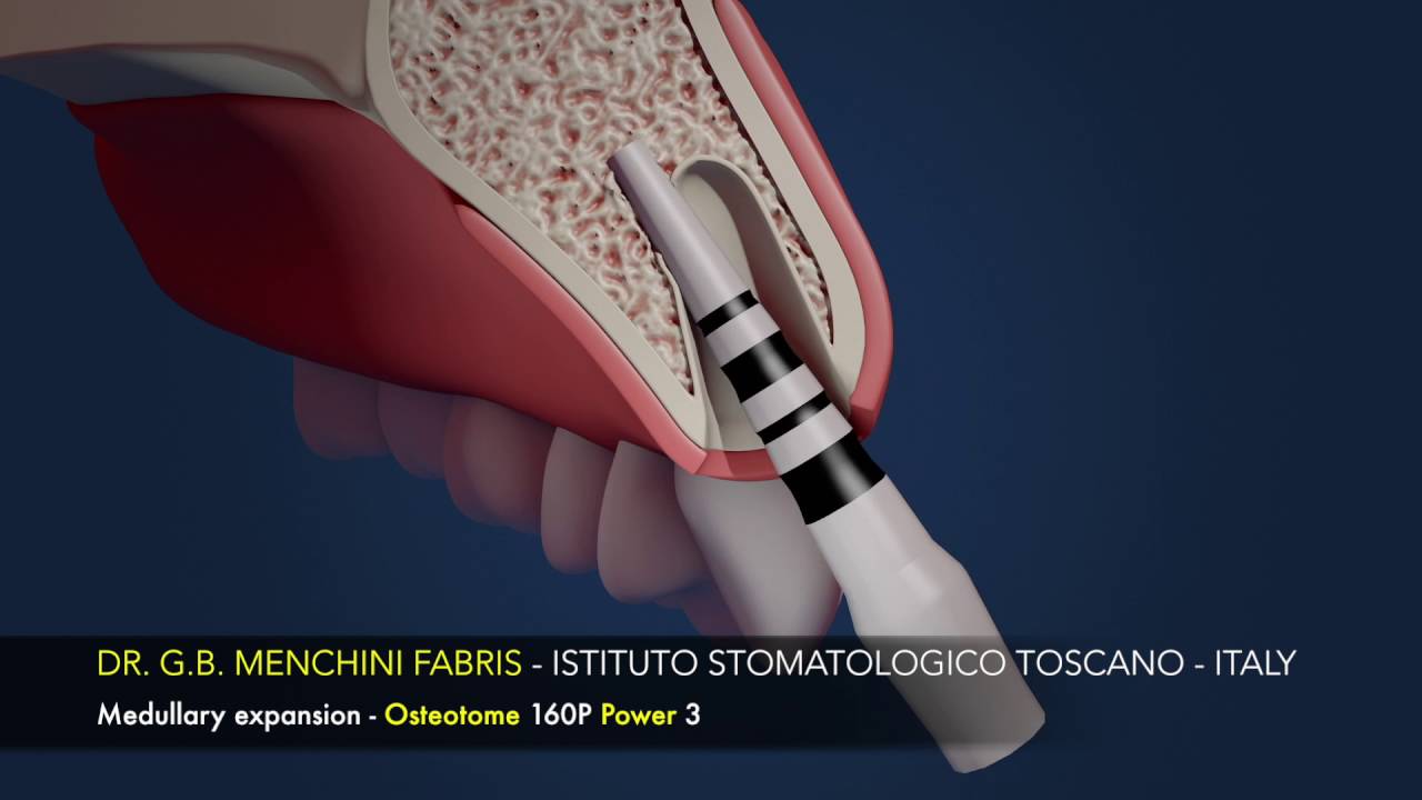 Immediate loading on post ex site Mallet approach YouTube