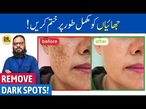Chehre Ki Chaiyan/Jhaiya Ka Khatma | Fade Hyperpigmentation, Dark/Age Spots
