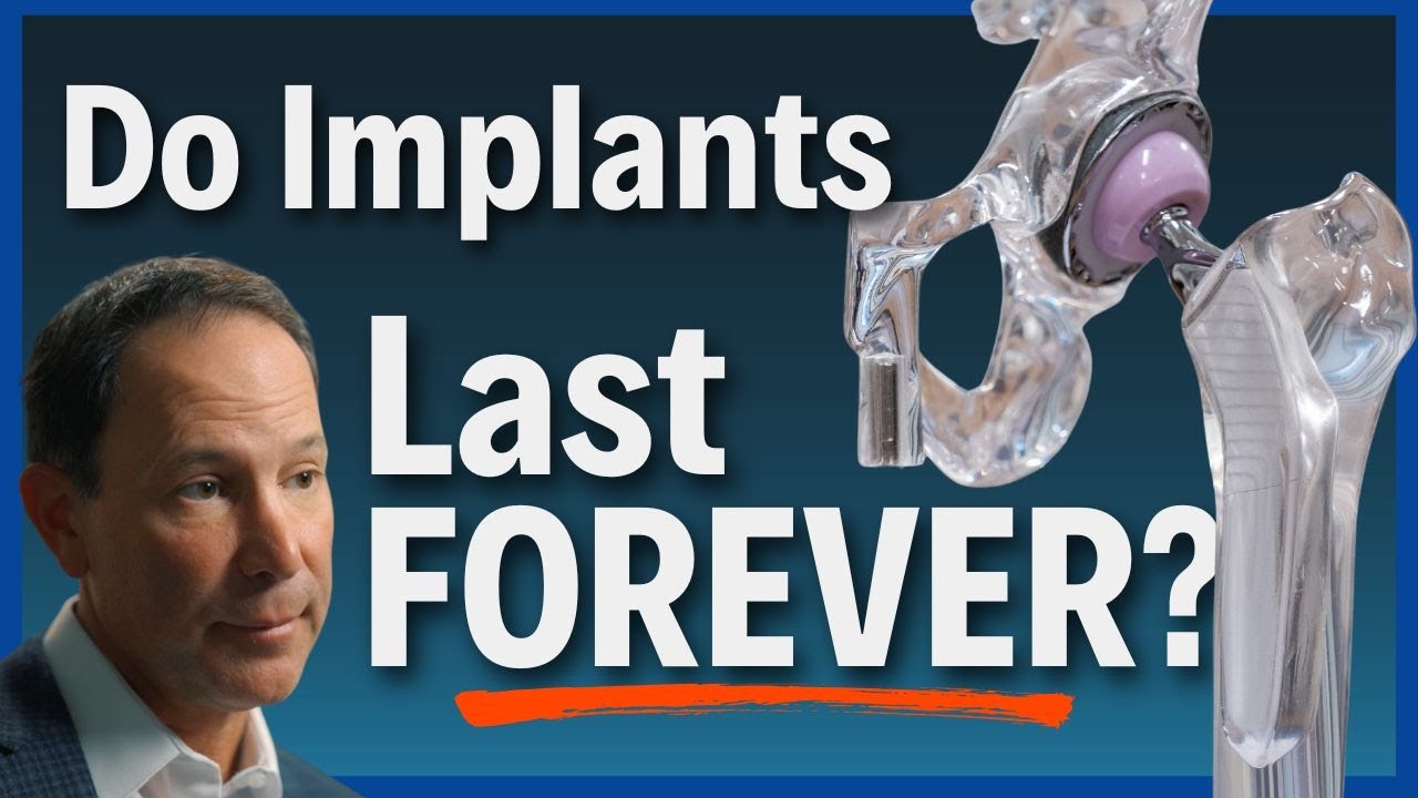 Will My Hip or Knee Implant Last a LIFETIME? Explained Step-by-Step