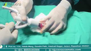 ZSR Circumcision in Jaipur | Painless & Stitchless Surgery by Dr Deepesh Goyal | Rejuvena Cosmo Care