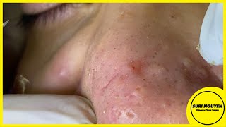 Suri Job 90 GREAT BLACKHEADS WHITEHEADS EXTRACTION