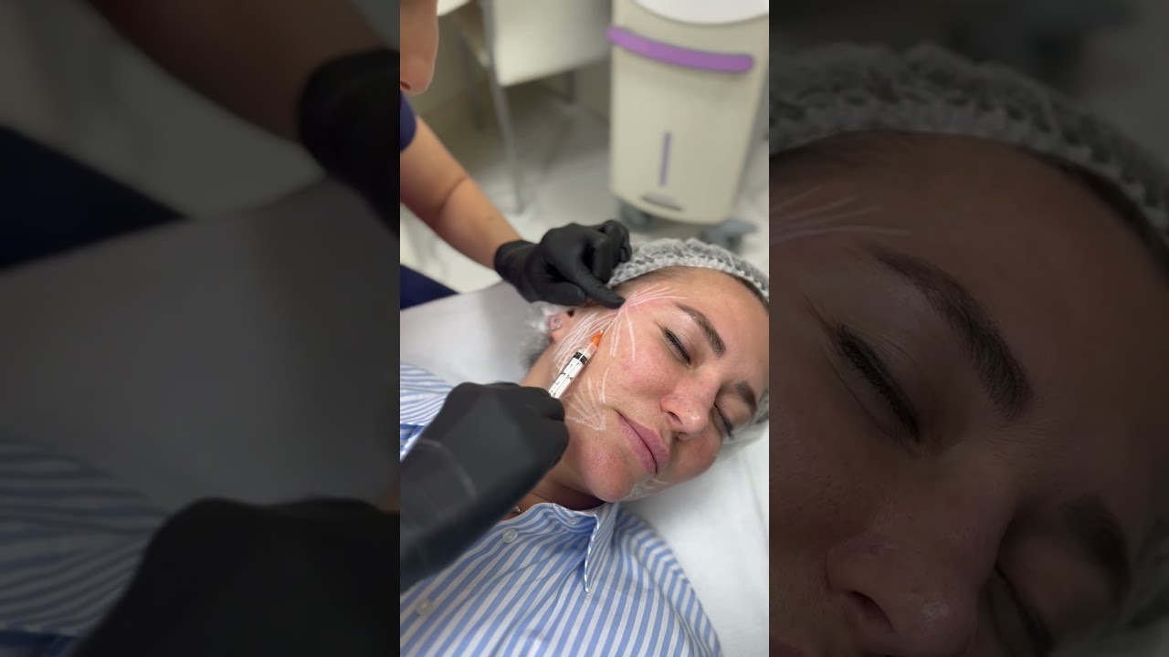 Векторный лифтинг AestheFill в Медицинском центре Ready Medical