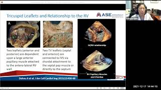 Part 2: Guidelines and Review of Tricuspid and Interatrial Septum/LAA Imaging Protocols