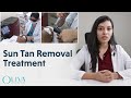 How To Remove Tan - Sun Tan Removal & Skin Lightening Treatments