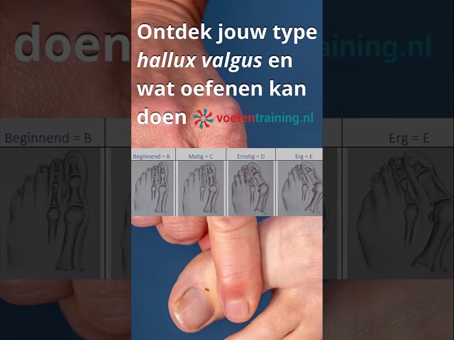 Welk type hallux valgus heb jij? Ontdek het met de Manchester scale