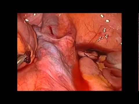 Anatomy of Triangle Doom