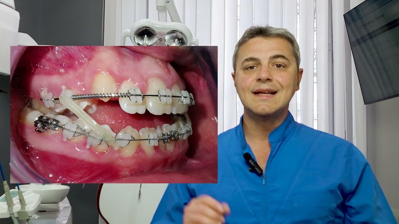 Mettere l'apparecchio fisso DUE VOLTE (Ep. 7)