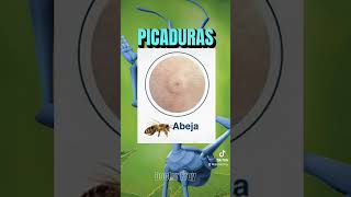 Tipos de PICADURAS de INSECTOS🦟