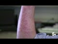 A Health Warning as Mosquito Season Starts Unusually Early