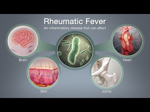 Acute Rheumatic Fever with Jones Criteria- Pathogenesis,  Diagnosis and Management with notes