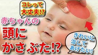もう心配しなくて大丈夫 赤ちゃんの頭皮にできる うろこ かさぶた 正しいケアできれいに治せます Youtube
