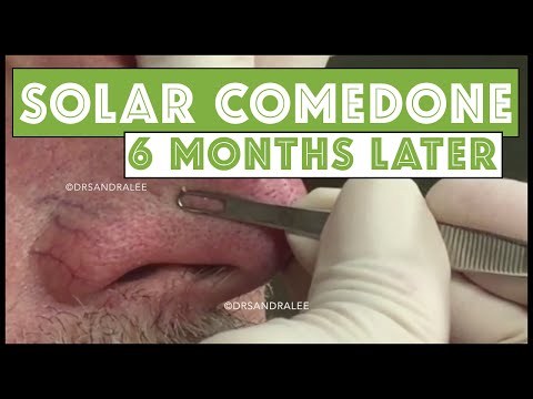 Blackheads / Solar Comedones Extracted Again, 6 Months Later