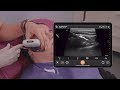 FACT: Masseter Muscle Injection [Facial Assessment with Clarius Techonology]