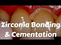 Zirconia Crown Cementation- Bonding Protocols by Etching, sandblasting & Ivoclar Multilink