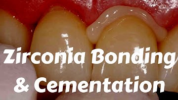 Zirconia Crown Cementation- Bonding Protocols by Etching, sandblasting & Ivoclar Multilink