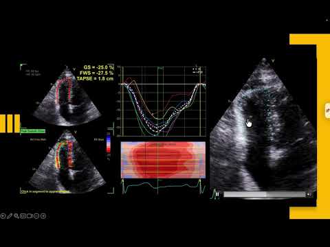 RV Strain Simplified: Views, ROI & Variability Explained. Why Your Numbers May Not Be Right🫀⚠️
