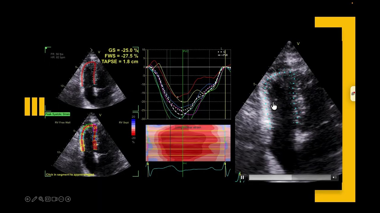 RV Strain Simple: Views, ROI & Variability Explained. Why Your Calculations May Not Refits🫀⚠️