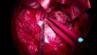 Удаление гемангиобластомы 4 желудочка. Нейрохирург Землянский М.Ю.