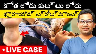 సర్జరీ లేకుండా థైరాయిడ్ గడ్డ చికిత్స | LIVE Treatment of Thyroid Nodule Without Surgery (RFA)