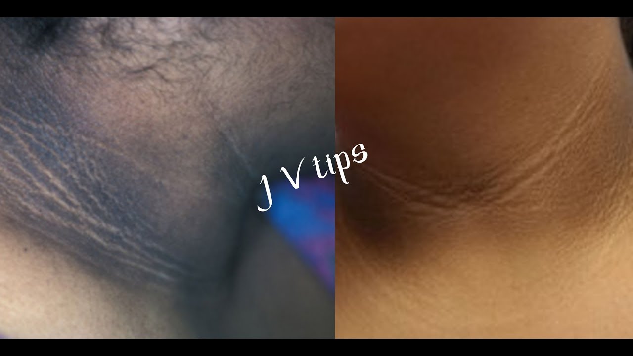YOU CAN SIMPLY REMOVE BLACK NECK EASILY AT HOME - YouTube