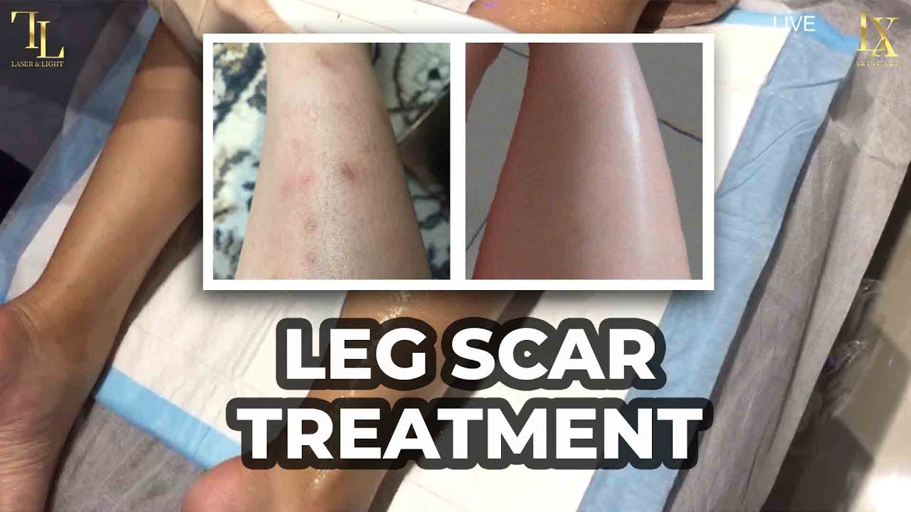 Dark Scars on Leg [Scar Treatment]⚡️ 