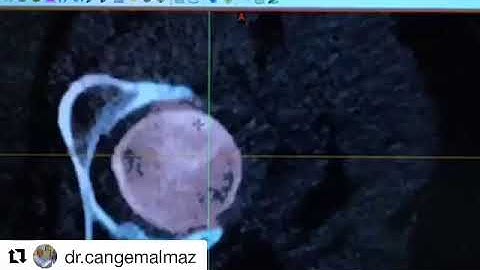 Mimics Innovation Suite ile Ortopedide 3Boyutlu Teşhis ve Tedavi