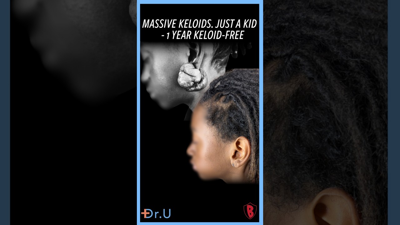 Massive Keloids. Just a Kid - 1 Year keloid Free