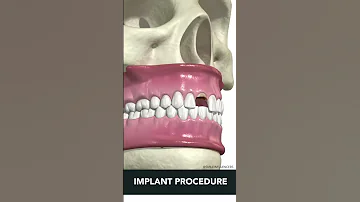 Tooth Implant Procedure STEP BY STEP 
