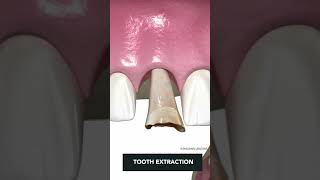 Tooth Implant Procedure {STEP BY STEP}