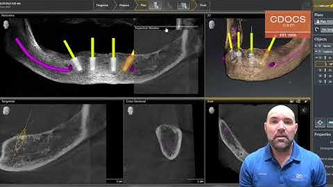 Tip of the Day: Angled Abutments