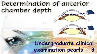 Determination of anterior chamber depth |Undergraduate Clinical Examination Pearls 3