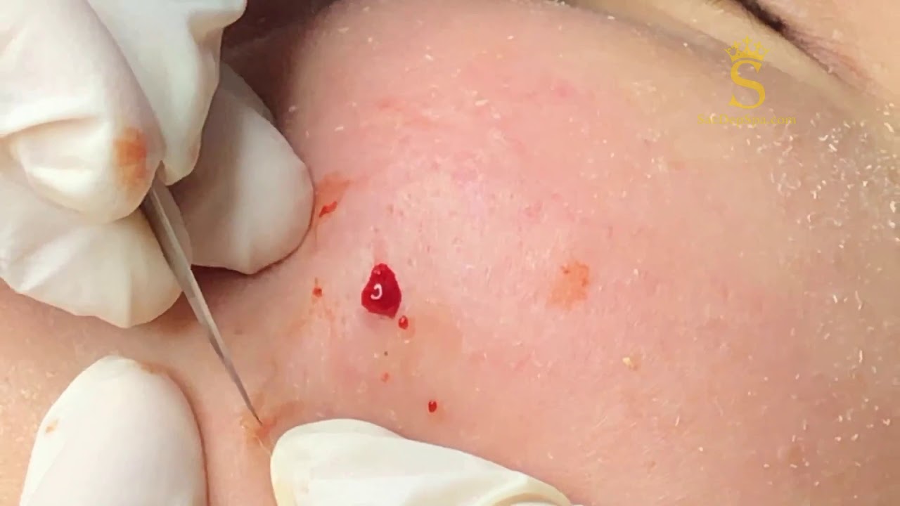 Mụn Cứ Trồi Ra Xem Mà Đã Mắt