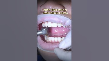 Kết thúc 2 năm niềng răng đầy xứng đáng