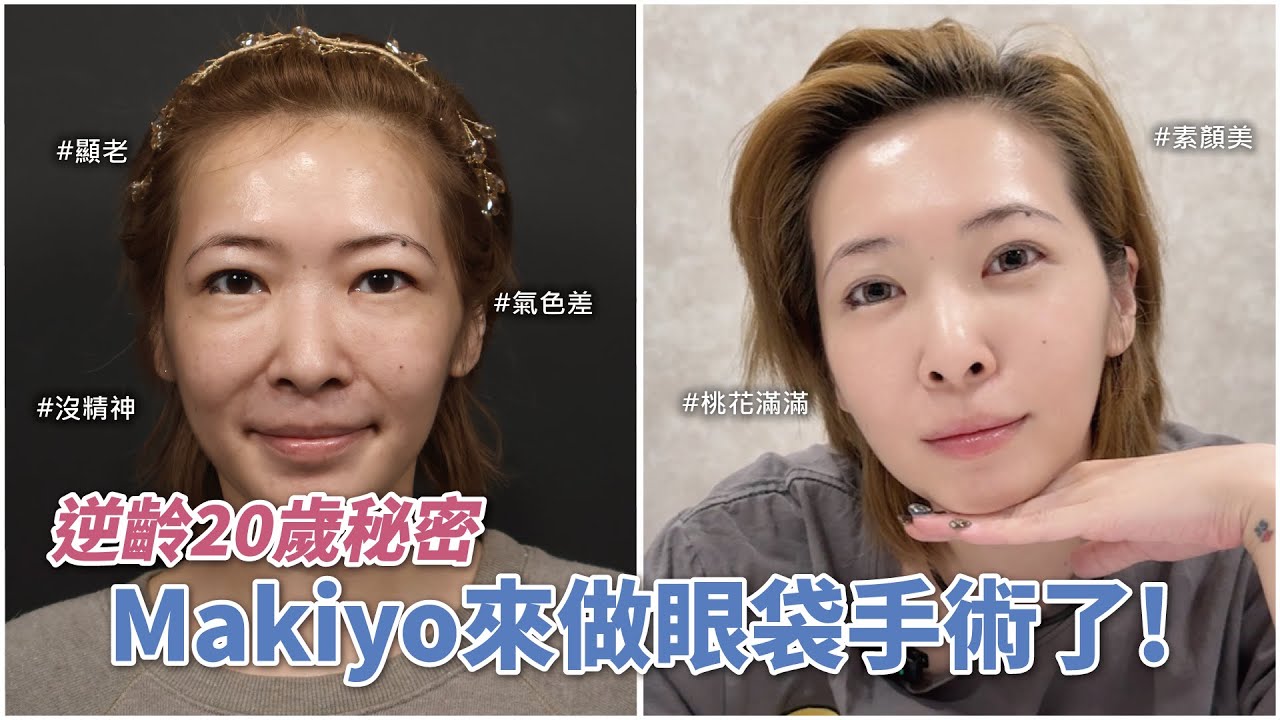 Makiyo來做眼袋手術了 逆齡20歲的秘密
