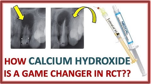 How CALCIUM HYDROXIDE is a GAME CHANGER in RCT // CAOH // ENDODONTICS // DENTAL EDUCATION