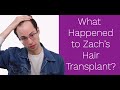 Zach From The Try Guys Hair Transplant- What Happened?
