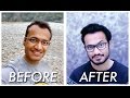 Hair Transplant | Before and After | 1 Year Post Surgery