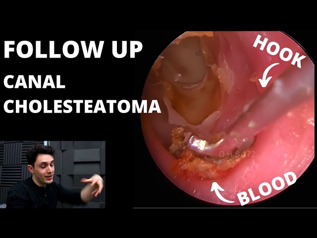 FOLLOW UP: Canal Cholesteatoma Patient Is Back class=