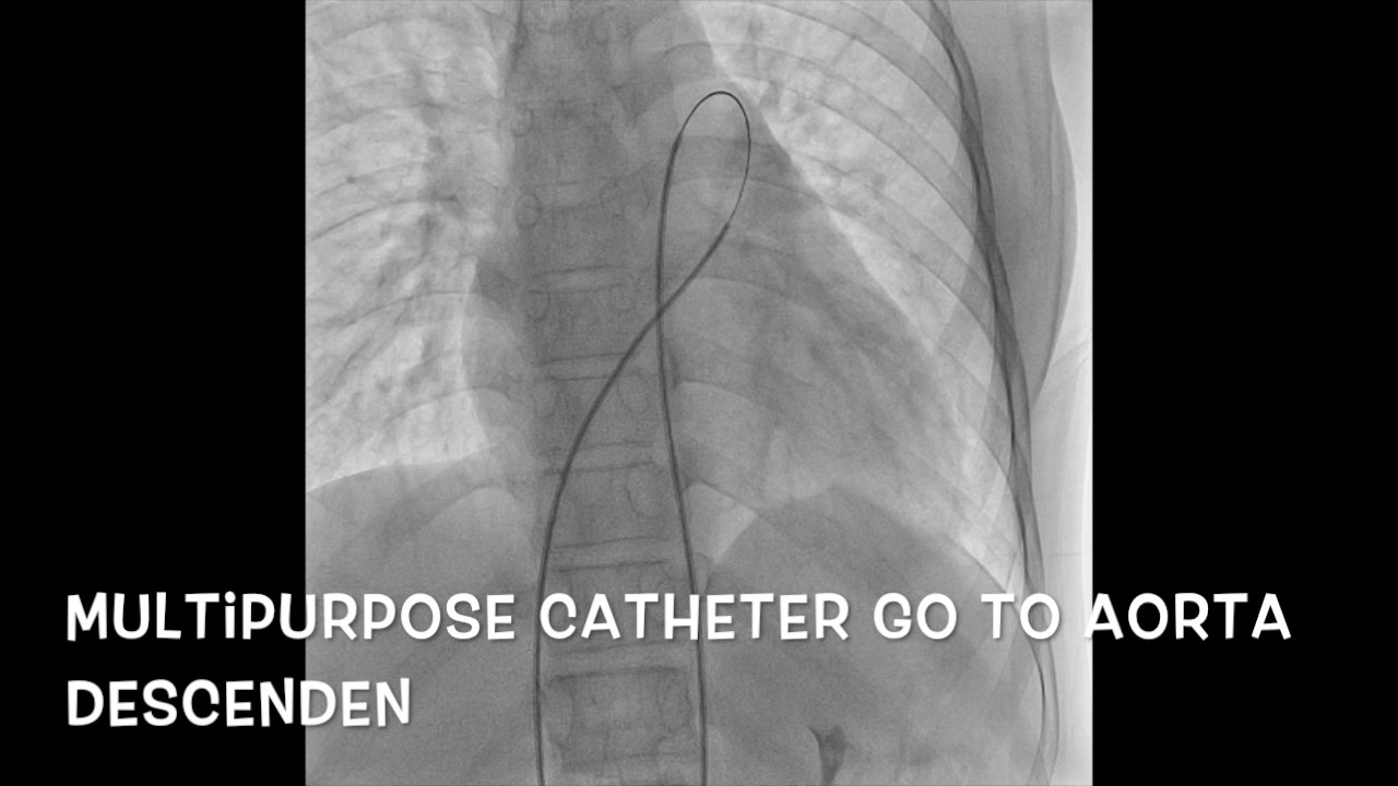 Step by step pda closure by snaring technique YouTube