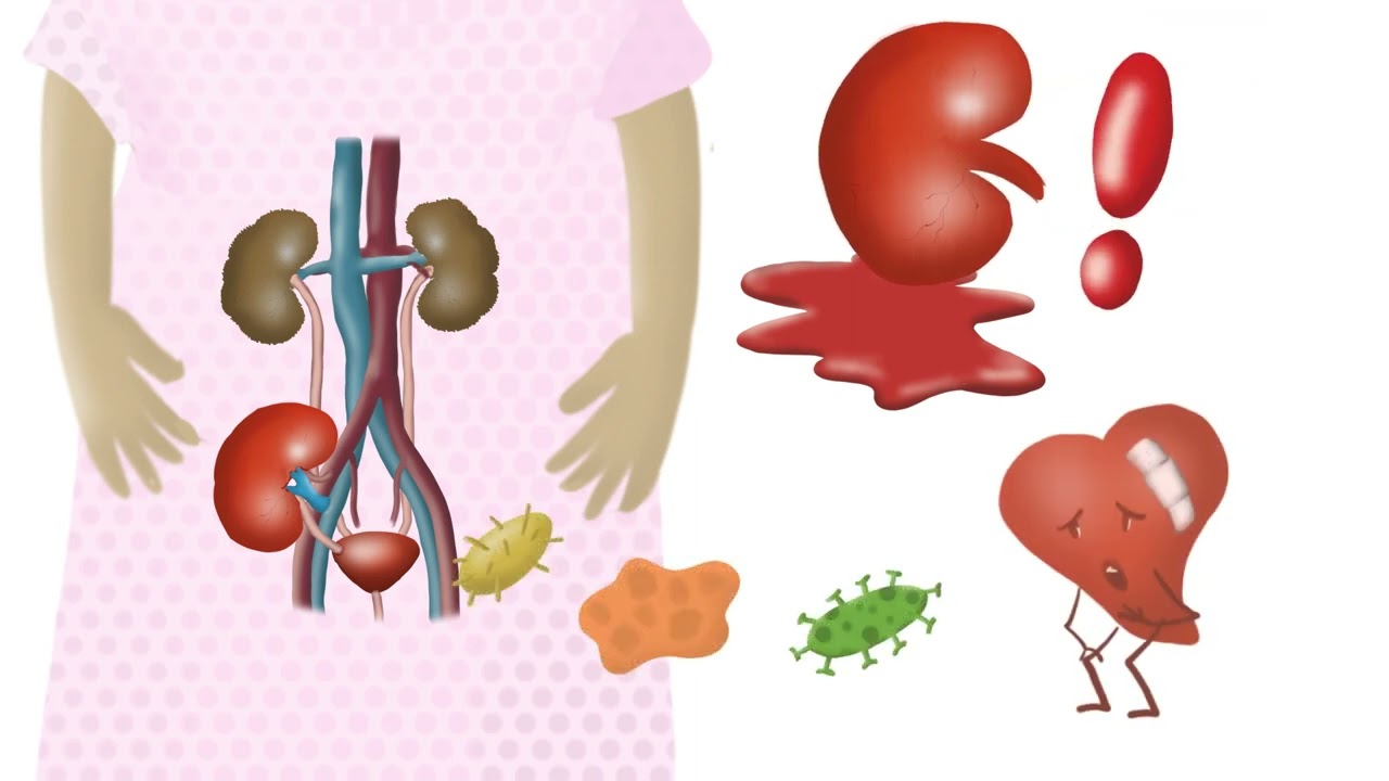 ¿En que consiste el trasplante renal?