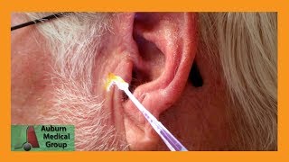 English Teacher's Ear Wax Removal | Auburn Medical Group