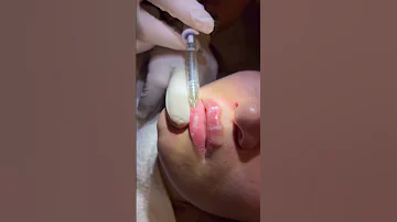 Dudak Dolgusu Hakkında Detaylı Bilgi Ve Randevu Için 0534 915 92 85 Ckklinik Cemkaras 