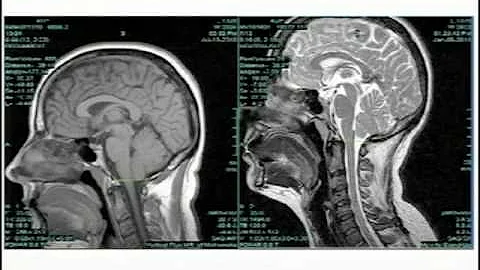 Cranio-Cervical Syndrome (CCS) Symposium - April 6, 2013, Raymond V. Damadian, MD.