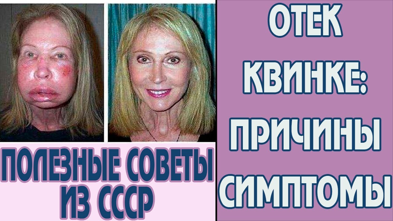 Как лечить отек Квинке на лице в домашних условиях. Отек Квинке ...