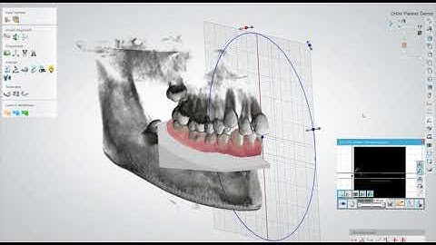 3shape Orthodontic Planner
