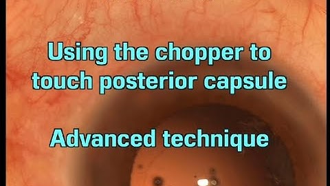 Using the chopper to  touch posterior capsule By Pedro Cabral MD