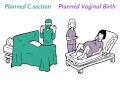 Cesarean or Vaginal Delivery for Twins.