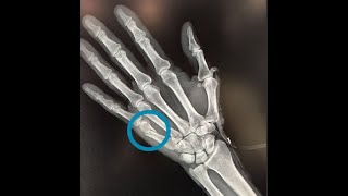 BOXER'S FRACTURE: FIFTH METACARPAL FRACTURE, CAUSES, SYMPTOMS, AND TREATMENT