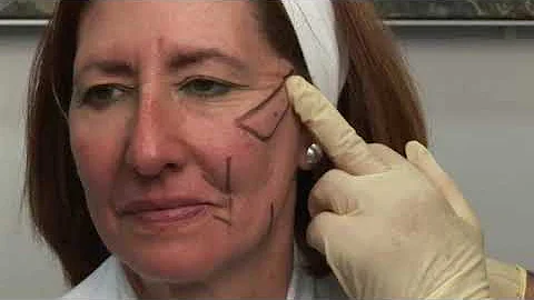 ¿Cómo quitar las arrugas de la cara sin cirugías?